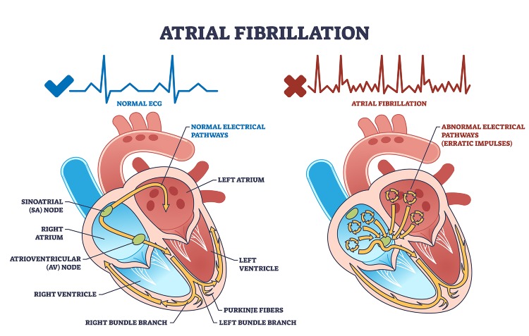 A diagram of a heart